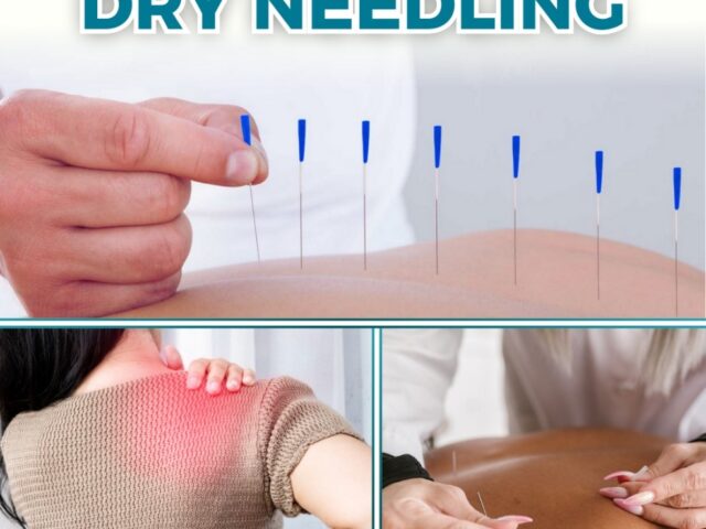 Dry Needling for Chronic Pain: A Drug-Free Pain Reliever